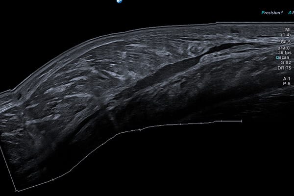 echographie musculaire du mollet centre radiologie imagerie irm medicale ouest parisien cimop paris 16 rueil malmaison sevres saint cloud