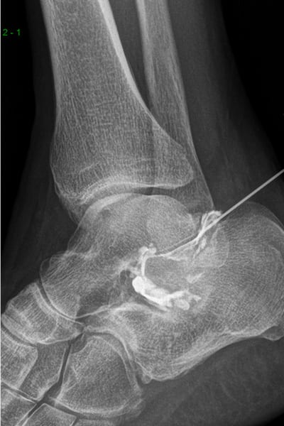 infiltration articulation sous talienne radiographie centre radiologie imagerie irm medicale ouest parisien cimop paris 16