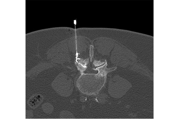 infiltration cortisonee scanner articulaire posterieure centre radiologie imagerie irm medicale ouest parisien cimop paris 16