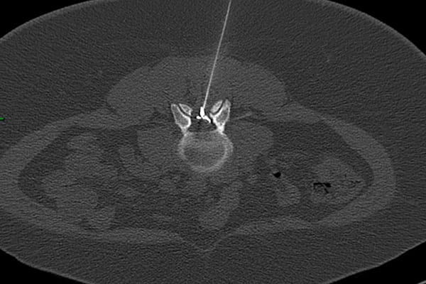 infiltration cortisonee scanner espace epidural centre radiologie imagerie irm medicale ouest parisien cimop paris 16