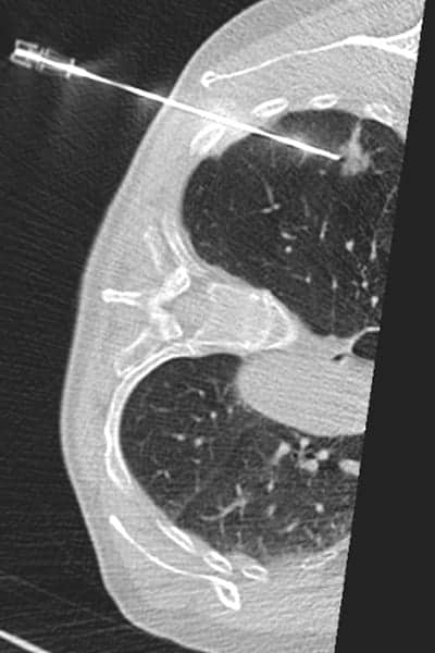 ponction biopsie percutanee centre radiologie imagerie irm medicale ouest parisien cimop paris 16