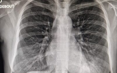 Une pneumonie suspectée en échographie
