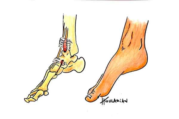 rupture tendon tibial antérieur traitement centre radiologie imagerie irm medicale ouest parisien cimop paris 16