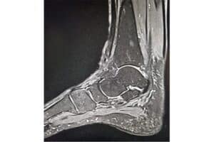 rupture tendon tibial postérieur symptome centre radiologie imagerie irm medicale ouest parisien cimop paris 16