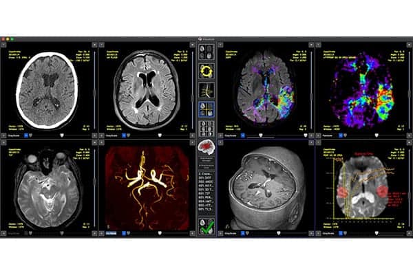 AVC ischemique aigu en scanner et IRM avec mismatch perfusionnel centre radiologie imagerie irm medicale ouest parisien cimop paris 16